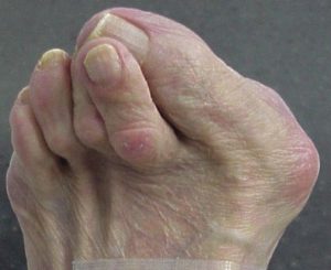 Hamer toe surgery