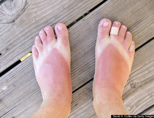 Sunburn on Feet……Ouch!