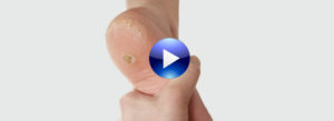 Plantar Warts