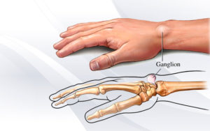 ganglion cyst