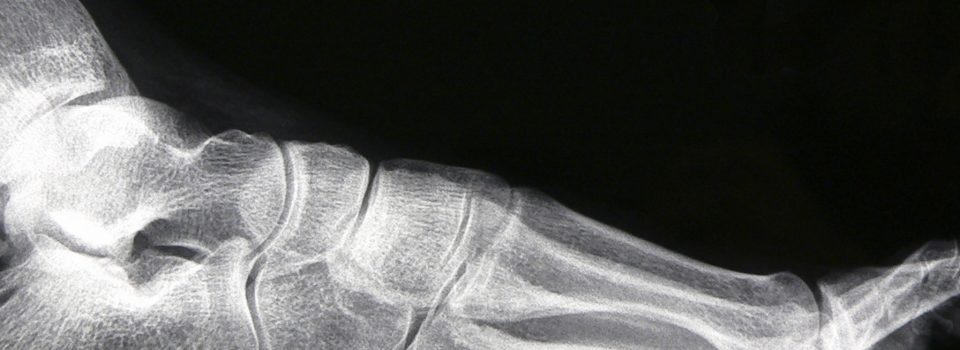 Haglund’s Deformity / Retrocalcaneal Exostosis