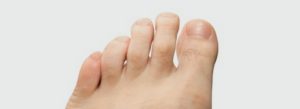 Hammertoe Deformity