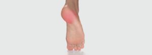 Plantar Fasciitis / Heel Spur Syndrome