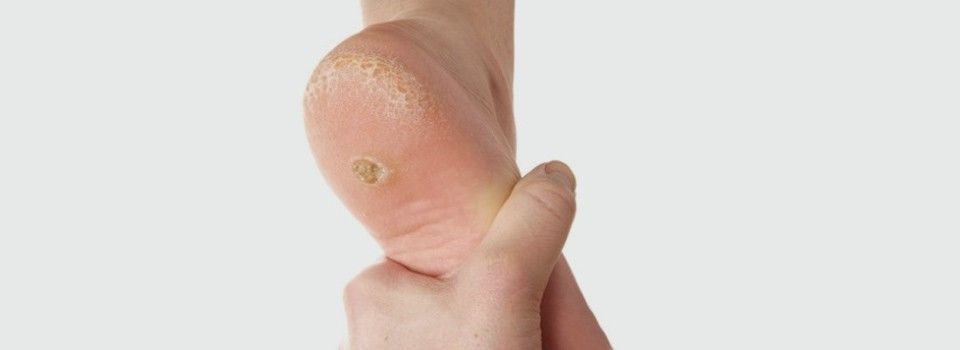 Plantar Warts