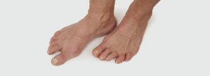 Rheumatoid Feet