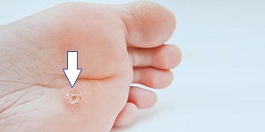 warts OR plantar WARTS