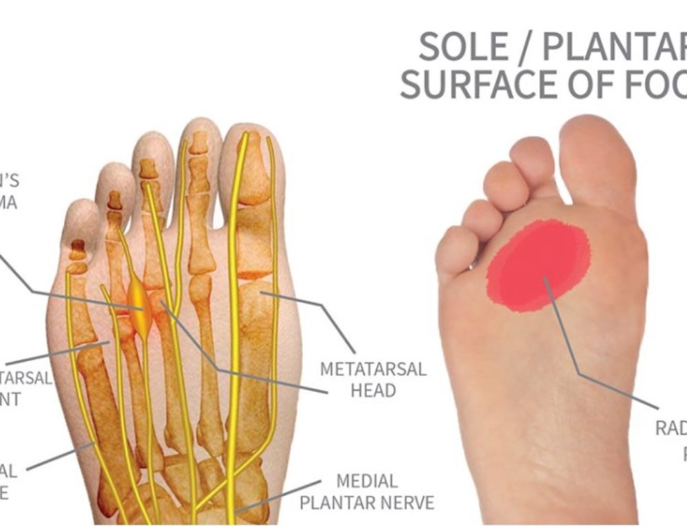 pain in second toe of foot