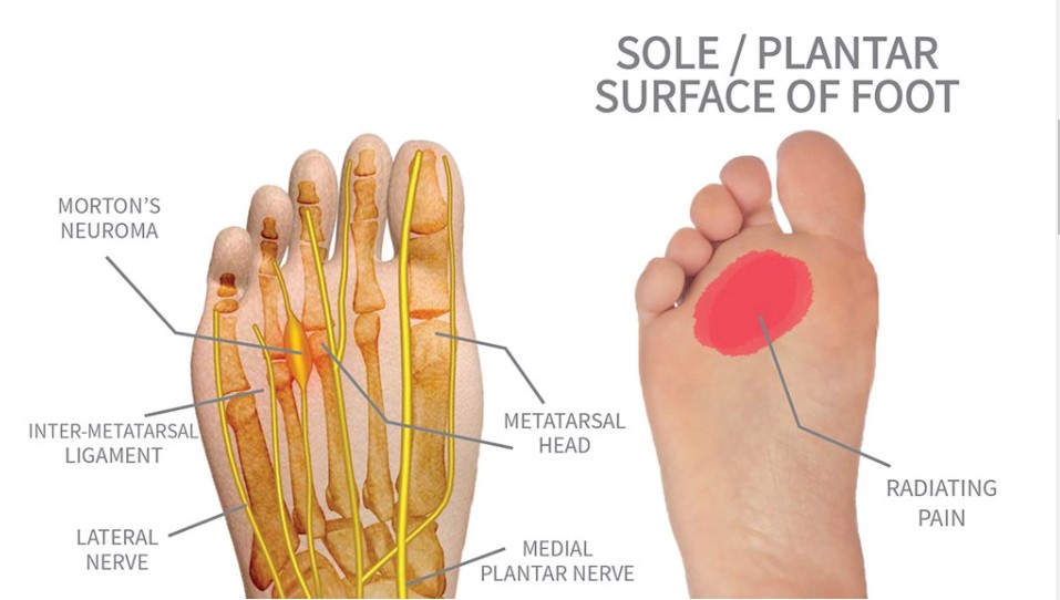Neuroma1